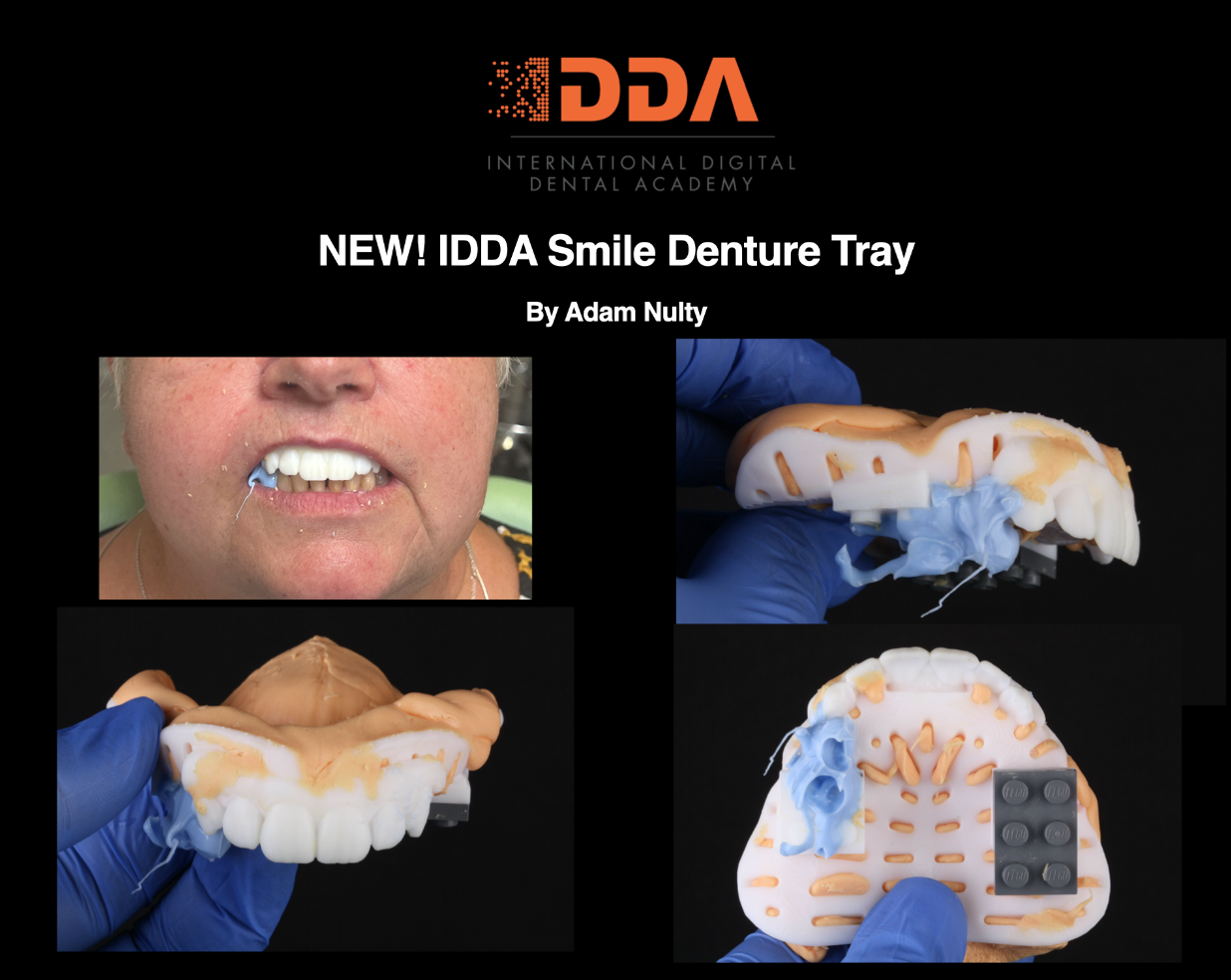 Custom Denture Tray Design with Custom Teeth