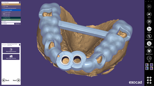 Surgical Guide Design & Print (1-3 Implants)