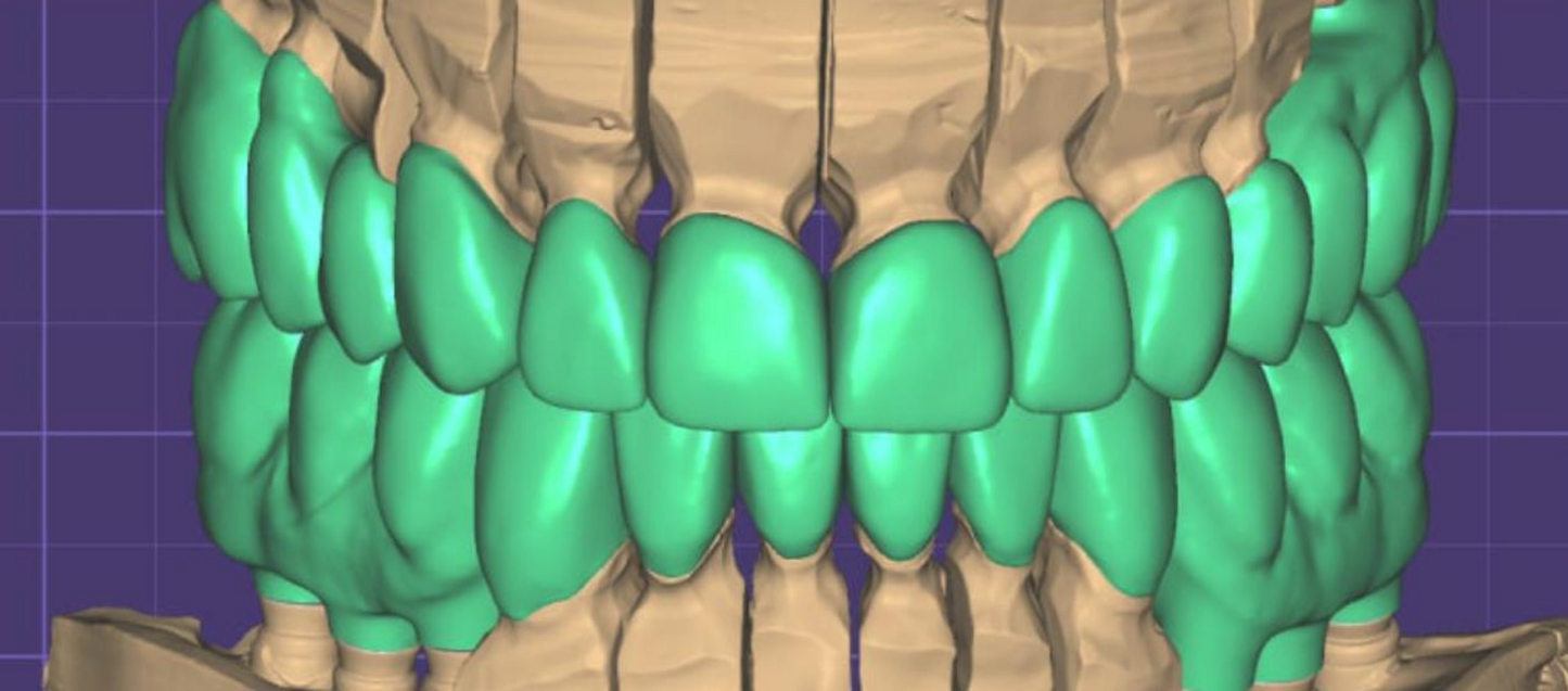 Smile Package - Ultimate Smile Design CAD FULL CASE