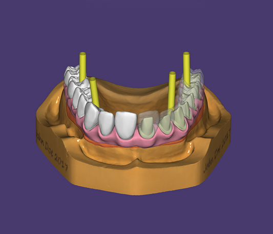 All On X Full Arch Implant Bridge - Try in OR Final