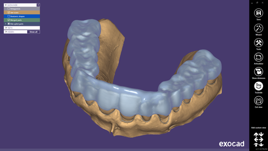 Mouthguard / Splint CAD Design