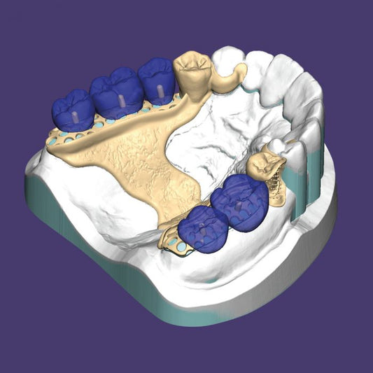 Partial Denture Design (Per Unit) (1 to 6 units.)